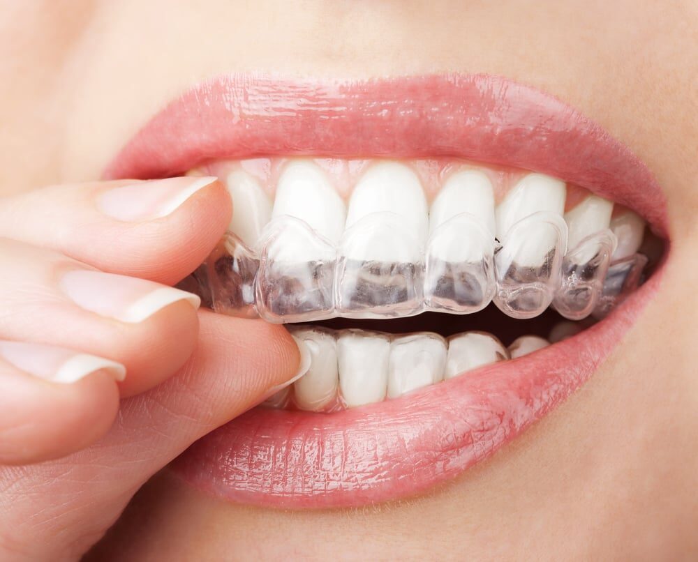 SureSmile clear aligner trays offered at Beck Dental Center